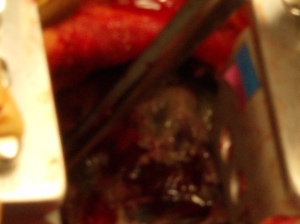 open thoracotomy,empyema, advanced with extensive purulence