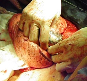 pulmonary metastatectomy in metastatic breast cancer