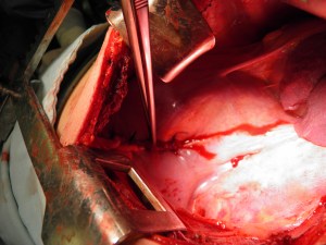 Example of sutured diaphragm - (view  from thoracotomy)  Photo courtesy of Dr. Ochoa, 2011.
