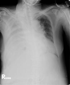 Chest radiograph on admission