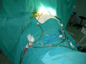infusing cisplatin solution via chest tubes