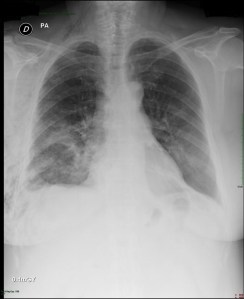PA & LAT films on post-operative day 2