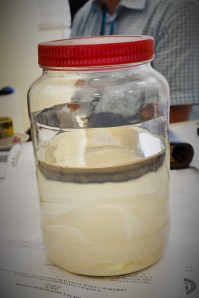 One of thousands of hydatid cysts removed by Dr. Yuksel