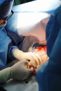 Harvesting the myocutaneous flap from posterior chest
