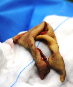 Skin harvested to cover flap site