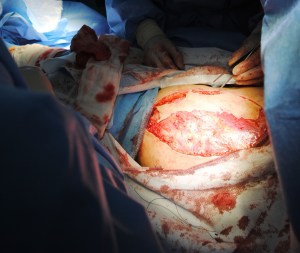 Skin grafting at the myocutaneous flap site